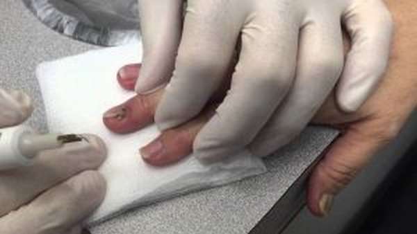 Обращение к хирургу после ушиба ногтя на руке